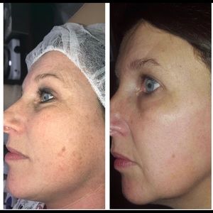 🧴 Chemical Peel    At-home Jessner Peel
